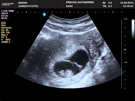 dating ultrasound around 8 weeks